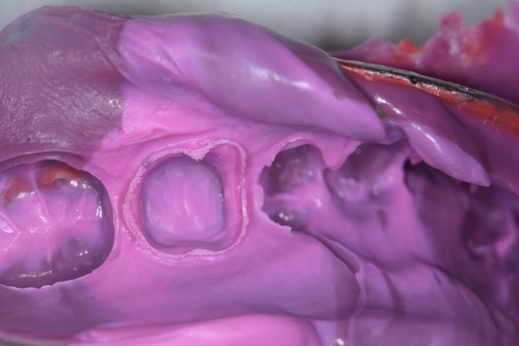 歯の精密な型取り