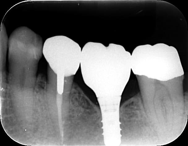 インプラントのレントゲン