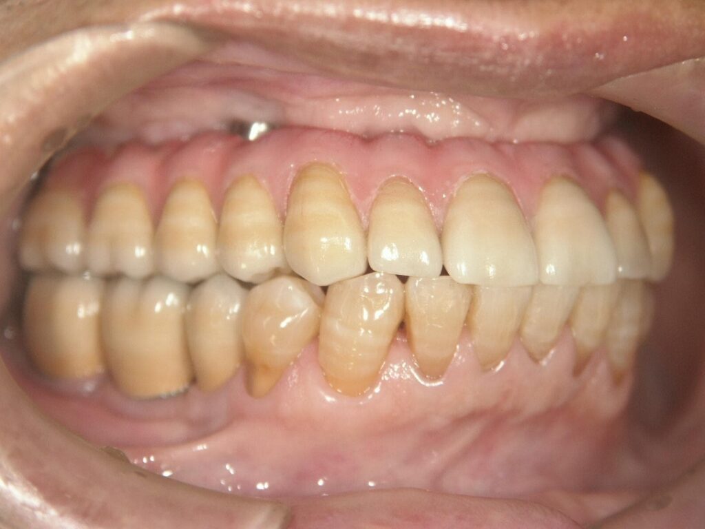 インプラント治療をした歯の様子