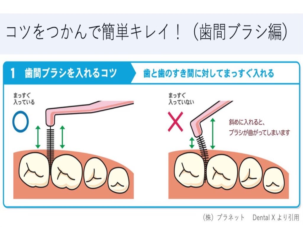 歯間ブラシの使用法