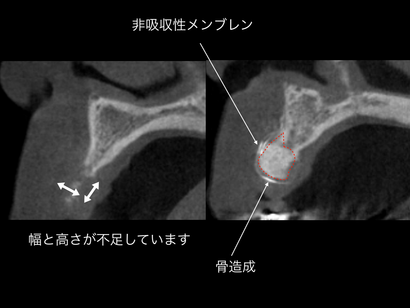 骨造成のビフォーアフター