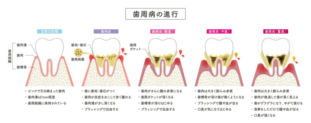 歯周病の進行