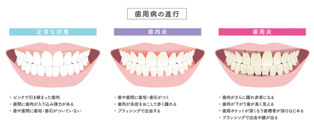歯周病の進行
