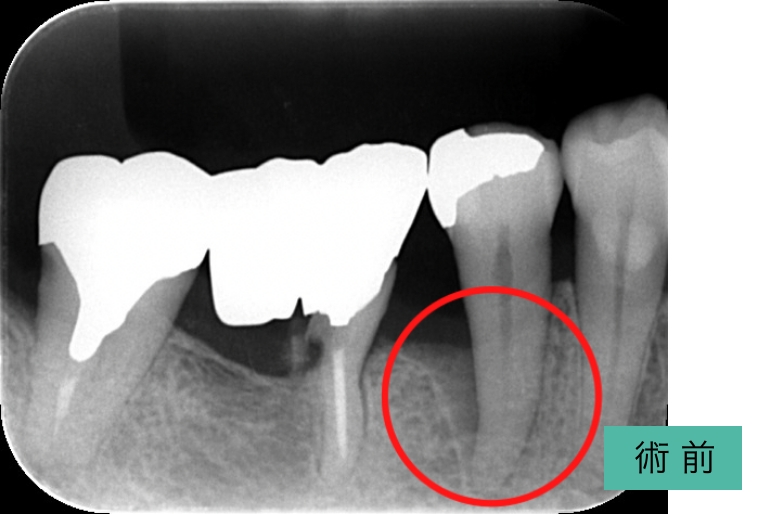 歯周組織再生療法