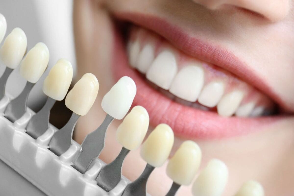 歯の色味確認、術前写真撮影