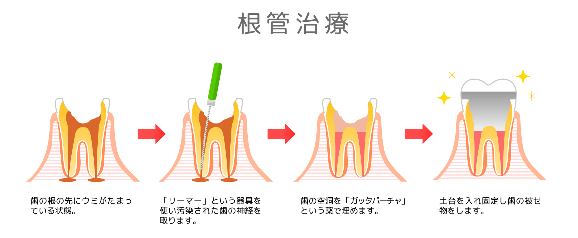 根管治療 卒後5年を支えるスタートガイド (歯科臨床 まずはここ