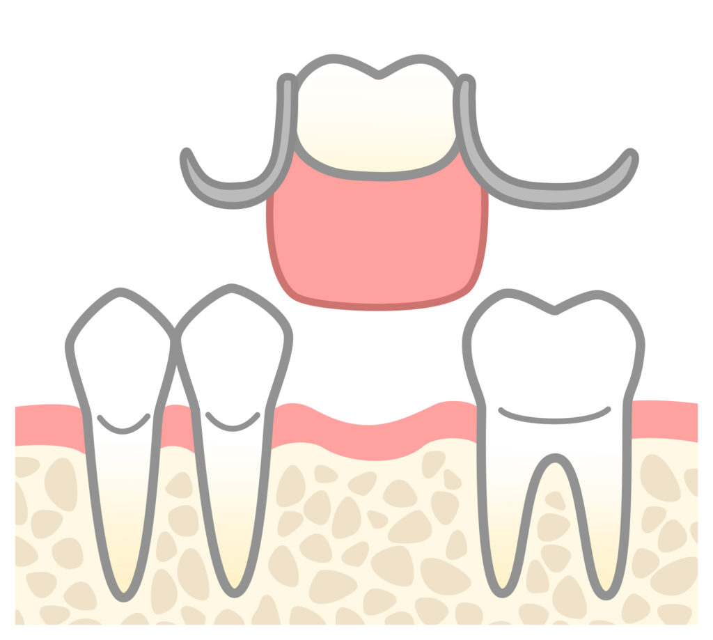 部分入れ歯（着脱式）