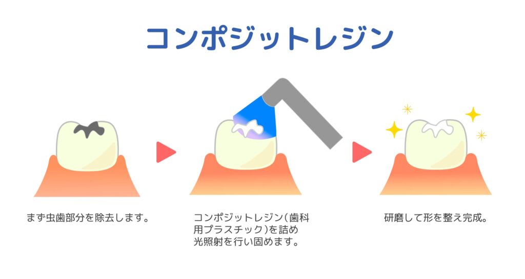 コンポジットレジンでの治療イメージ