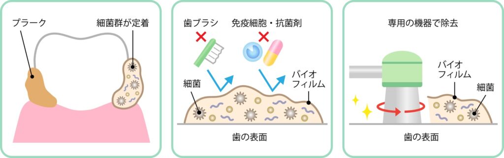 1回の治療で終わらないケース