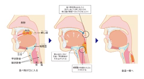 誤嚥性肺炎のイメージ