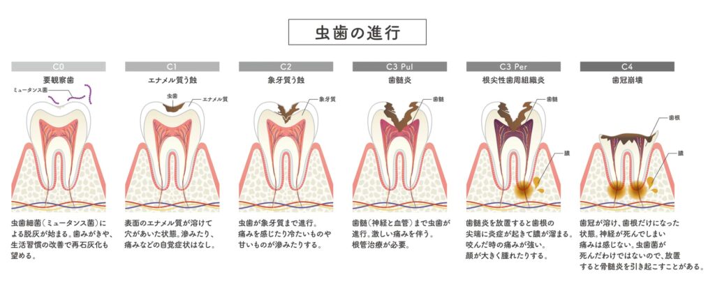 虫歯進行のイメージ
