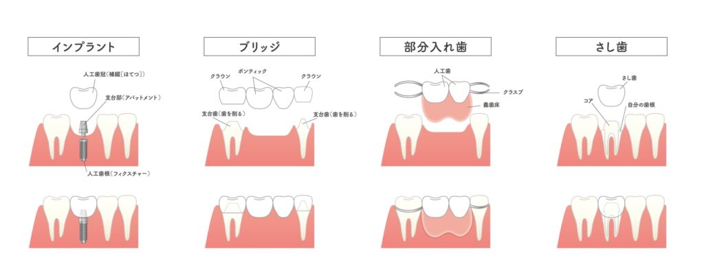前歯を失った場合の治療方法